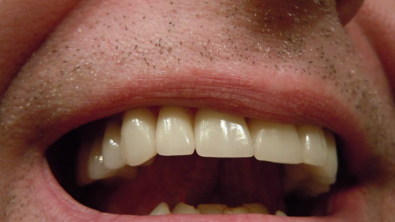 Przebarwienia między zębami
