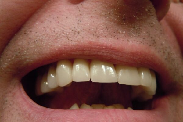 Przebarwienia między zębami